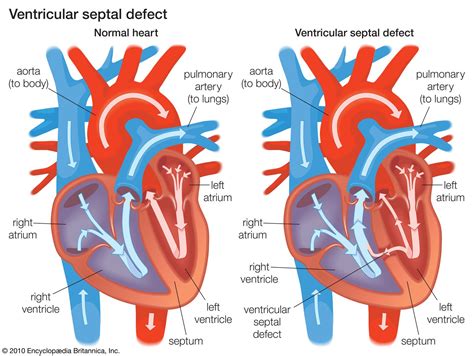 left ventricle meaning.